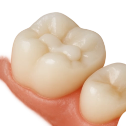 Close-up of a dental Filling on a tooth model, highlighting its function and importance